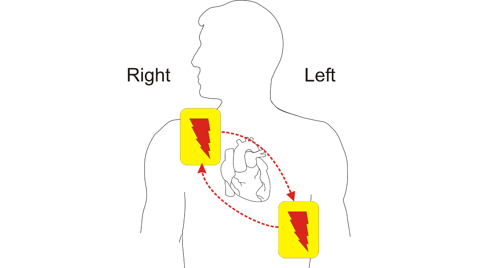 Diagram showing correct AED pad placement to ensure shock through axis of heart